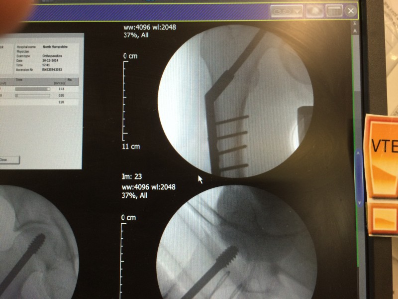 The plate and pins go down the femur. They told me it was a small cut but it looks about six inches long under the dressing.