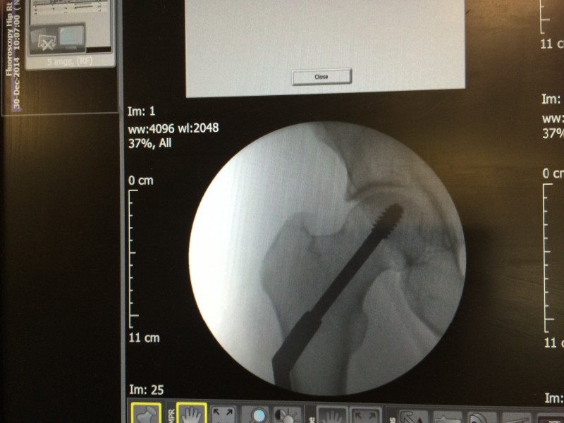 The upper part is threaded and the lower part below the break is unthreaded so the bone can move a little. Press-fit bones mend stronger apparently. 
